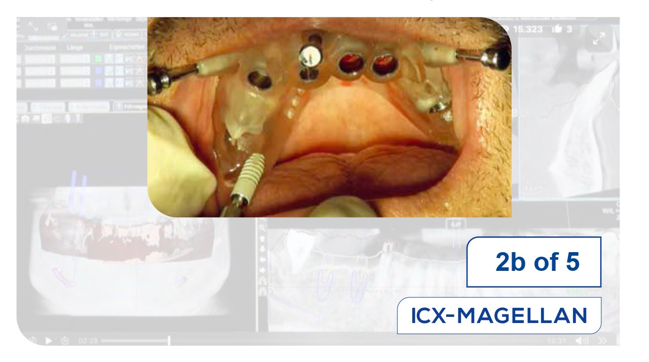 ICX-DIAMOND – elite implants