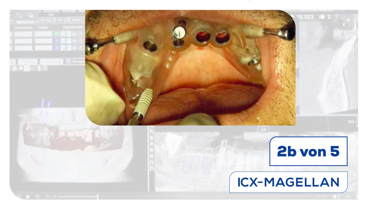 Geführtes Implantieren der ICX-DIAMOND Implantate